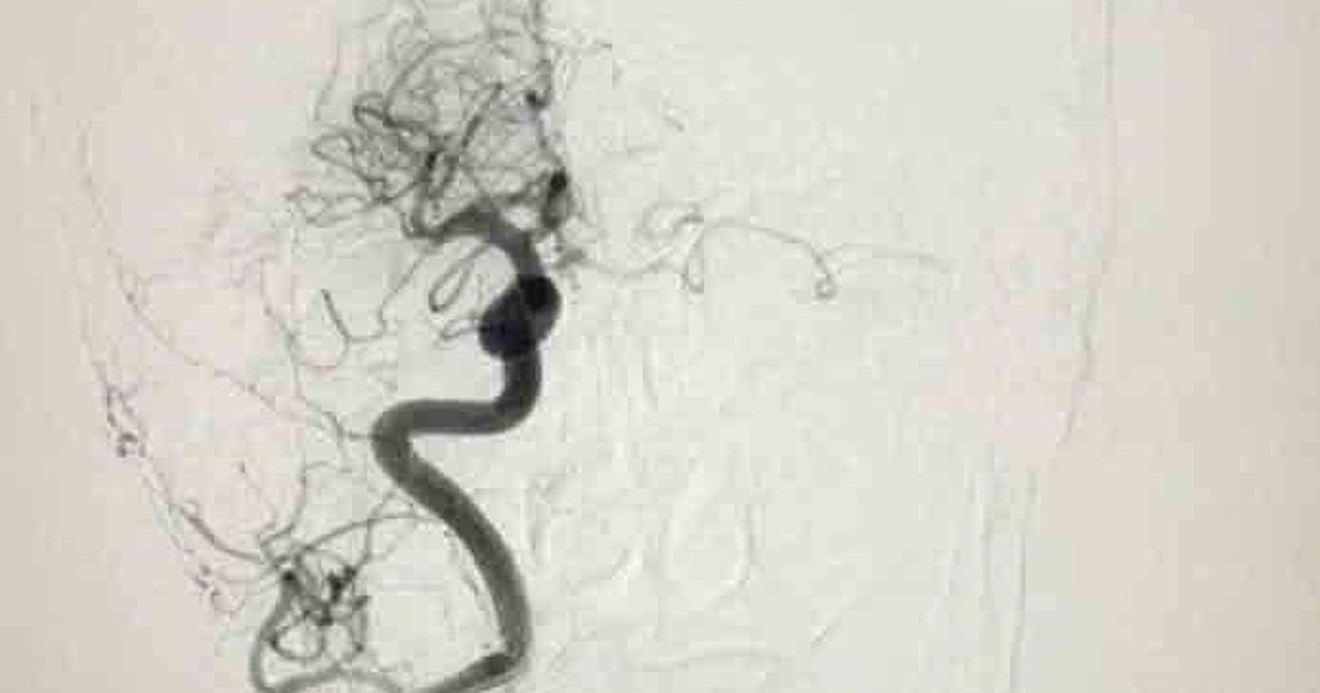 Đột quỵ do rung nhĩ: Hiểm họa từ việc tự ý bỏ thuốc