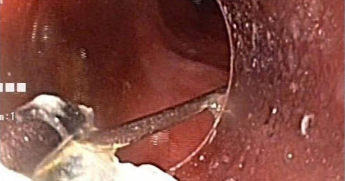 Nội soi lấy chiếc ghim nhọn 3 cm trong dạ dày bé 10 tuổi