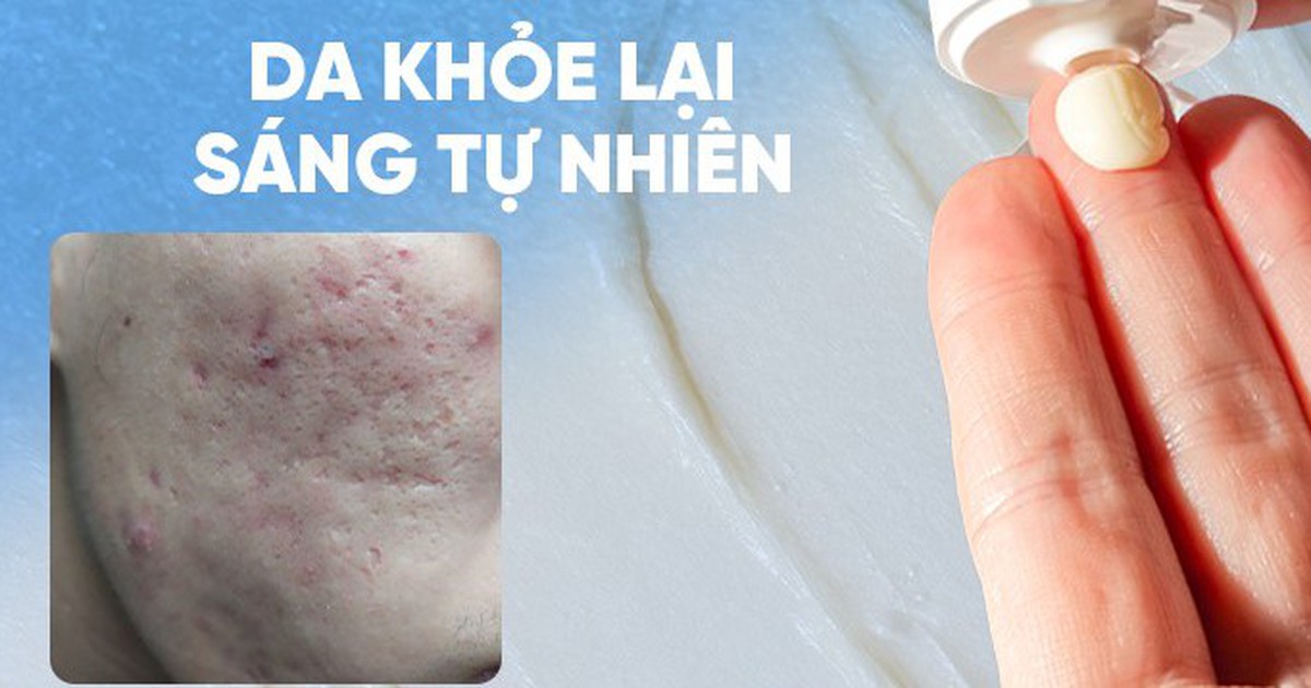 Review chi tiết kem Scar Esthetique làm mờ sẹo rỗ do mụn có tốt không?