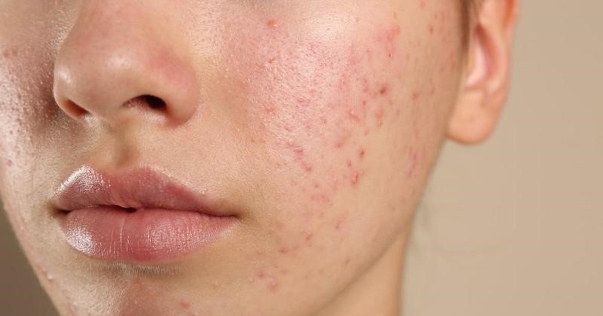 Kháng kháng sinh trong điều trị mụn và giải pháp thay thế từ tia Plasma lạnh