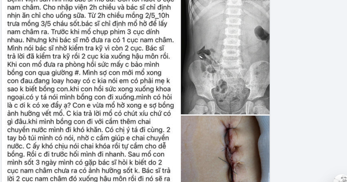 Bệnh viện lên tiếng vụ bệnh nhi bị "bỏ sót" nam châm khi mổ