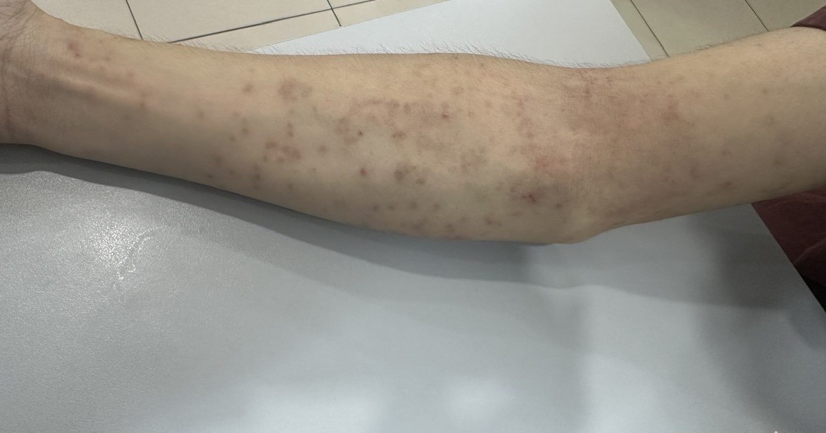Trị tận gốc viêm da mùa nắng nóng