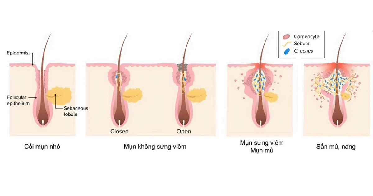 Gel chấm mụn nên dùng khi nào? Những lưu ý trước khi chấm mụn