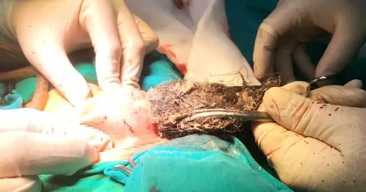 Phẫu thuật lấy búi tóc dài gần 20 cm trong dạ dày bệnh nhi mắc hội chứng Pica
