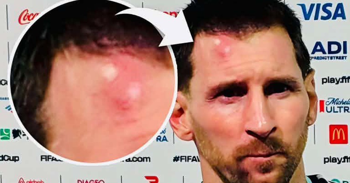 Messi sưng vêu trán sau trận thắng Cabo Verde: Vì sao nên nỗi?