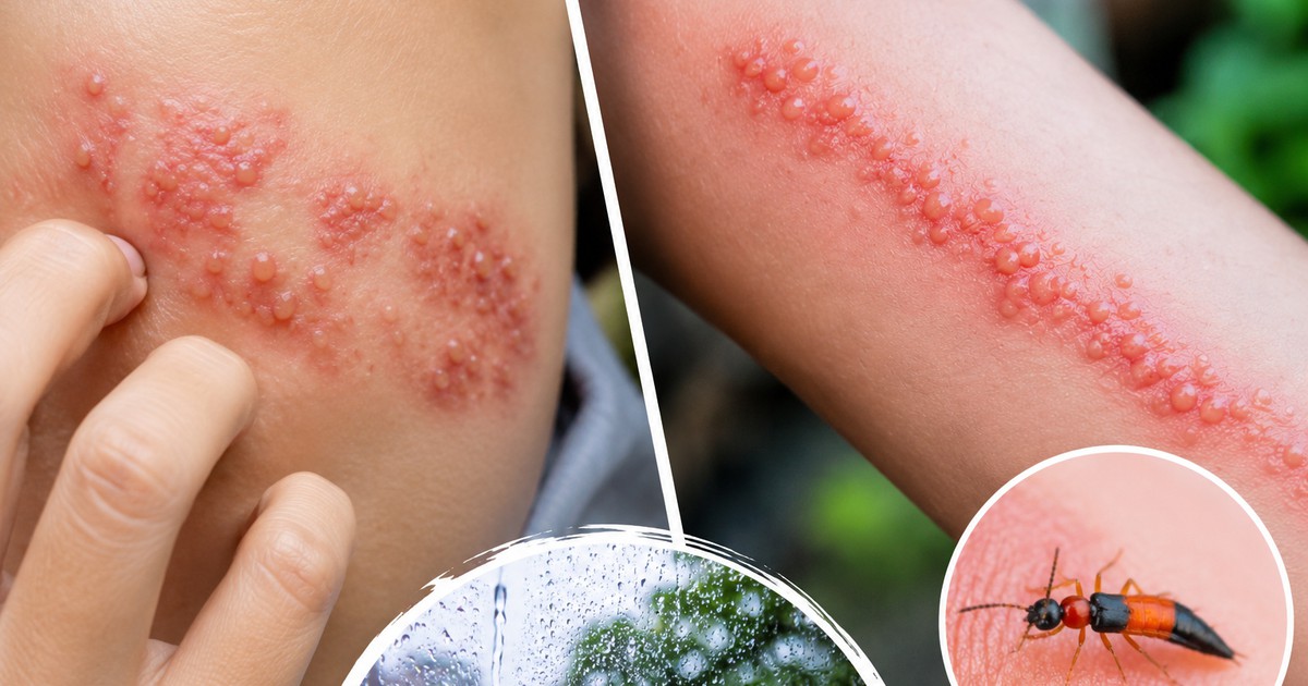 Nổi mụn nước, bỏng rát trên da: Làm sao biết do zona hay kiến ba khoang?