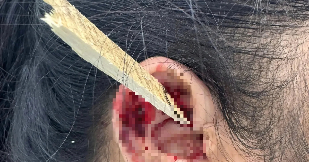 Mảnh gỗ dài 15 cm đâm xuyên tai nữ công nhân khi đang cưa gỗ
