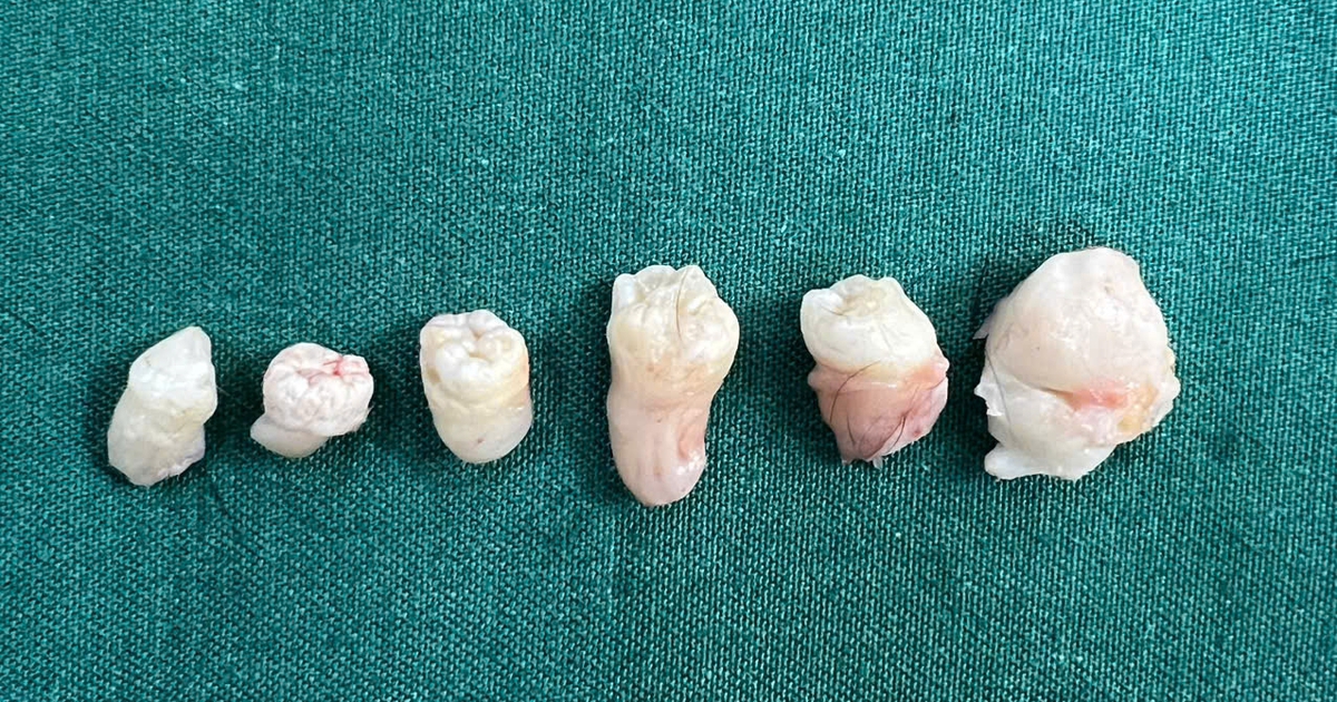 Hy hữu: Khối u trong bụng nữ bệnh nhân chứa 6 chiếc răng