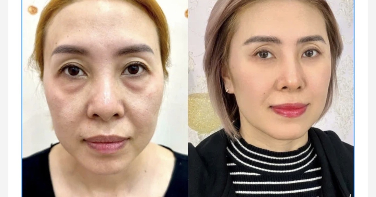 Xóa tan quầng thâm mắt bằng công nghệ Hydro Ultra Lift