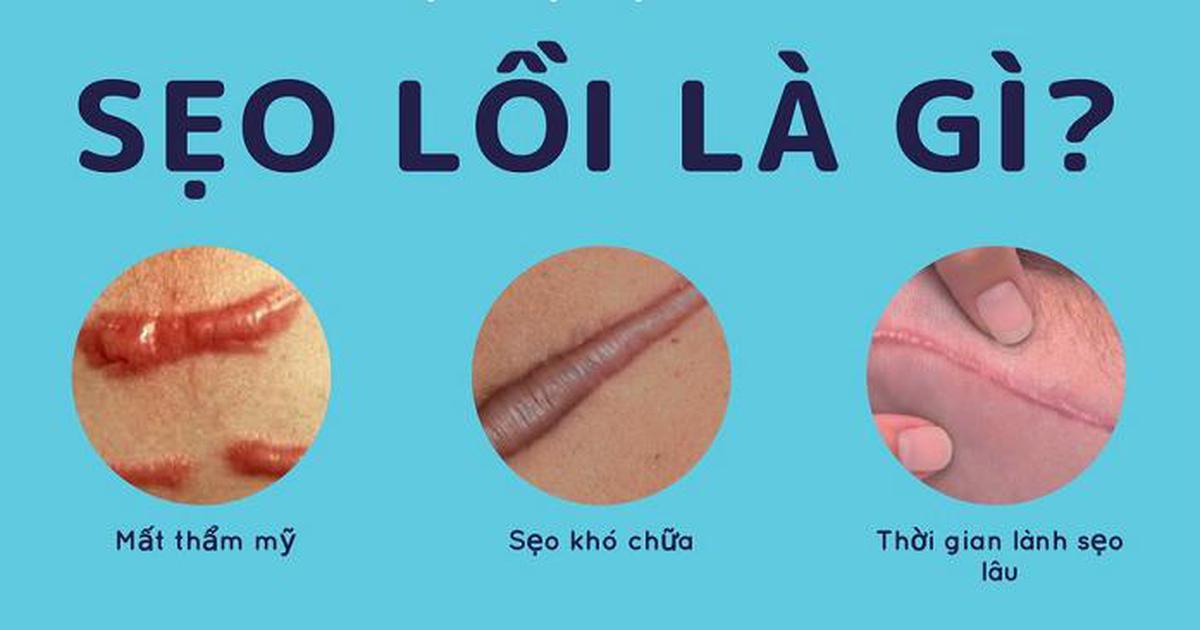 Sẹo lồi bao lâu thì hết? Chuyên gia da liễu trả lời khiến ai cũng bất ngờ