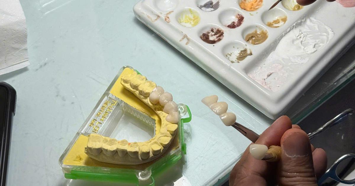 Làm sao biết được chất lượng thật của răng giả?