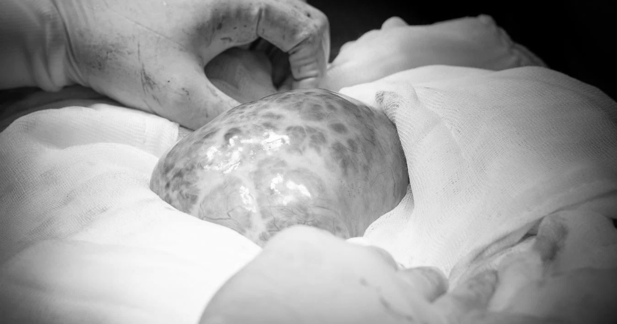 Người phụ nữ mang khối u buồng trứng gần 5 kg sau 10 năm bỏ tái khám