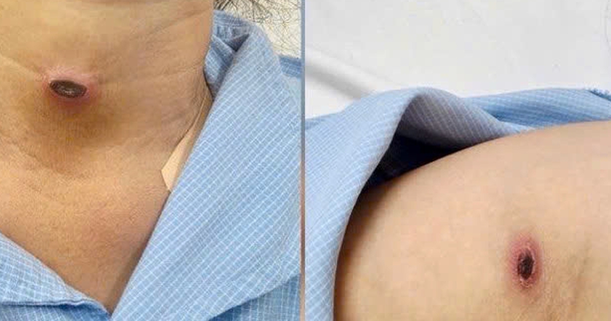 Nhận diện bệnh sốt mò