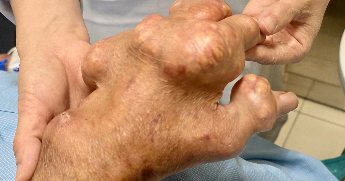 Các thực phẩm giúp kiểm soát axít uric ở người bệnh gout