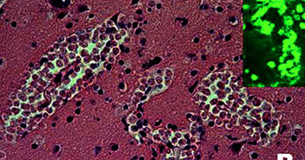 Đã có 2 trường hợp tử vong do amip "ăn não người"