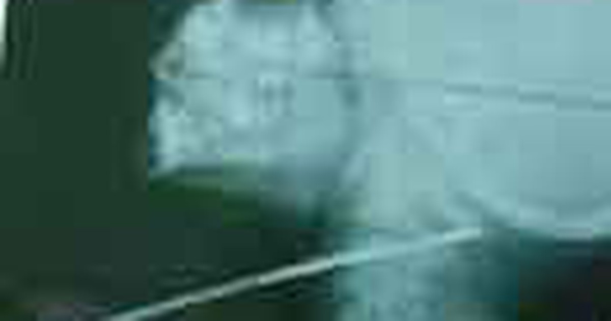 Cứu kịp thời bé trai bị nan hoa xe máy đâm xuyên cổ