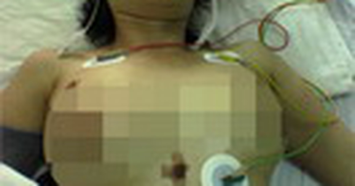 Một phụ nữ tử vong sau khi bơm silicon lỏng khắp người