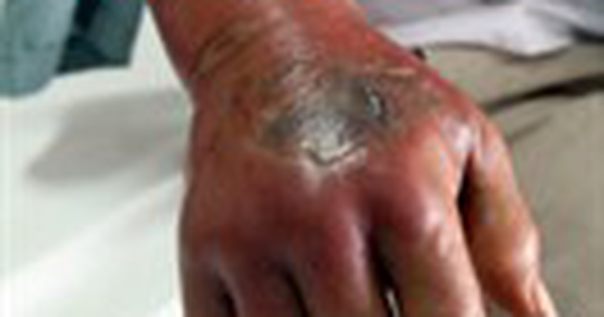 Nhiều ca nhập viện do rắn độc cắn