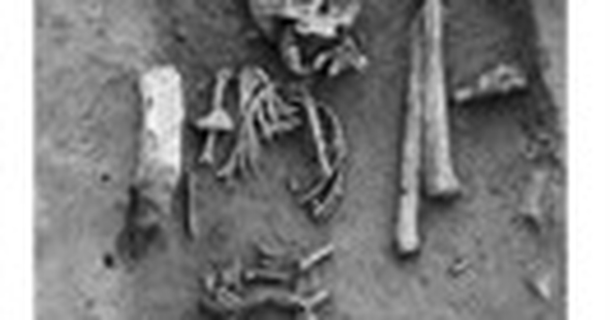 Ca bệnh Down sớm nhất trong lịch sử y học