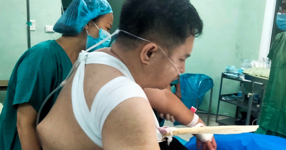 Cứu người đàn ông bị cây gỗ đâm xuyên ngực, thủng phổi