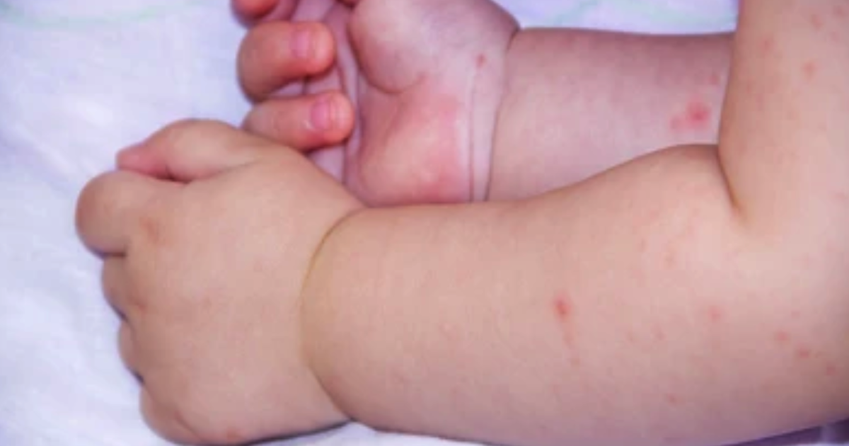 Bệnh tay chân miệng dễ nhầm lẫn với sốt mọc răng và bệnh khác