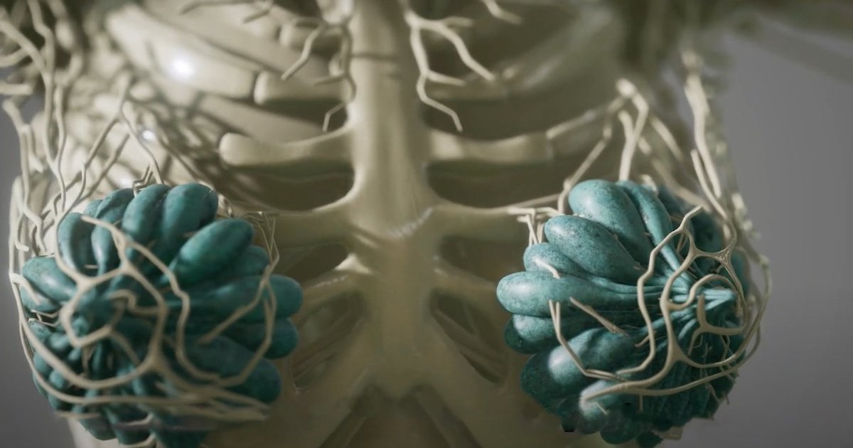 Hy hữu: Người phụ nữ bị vỡ túi nâng ngực khi đang mang thai 5 tháng