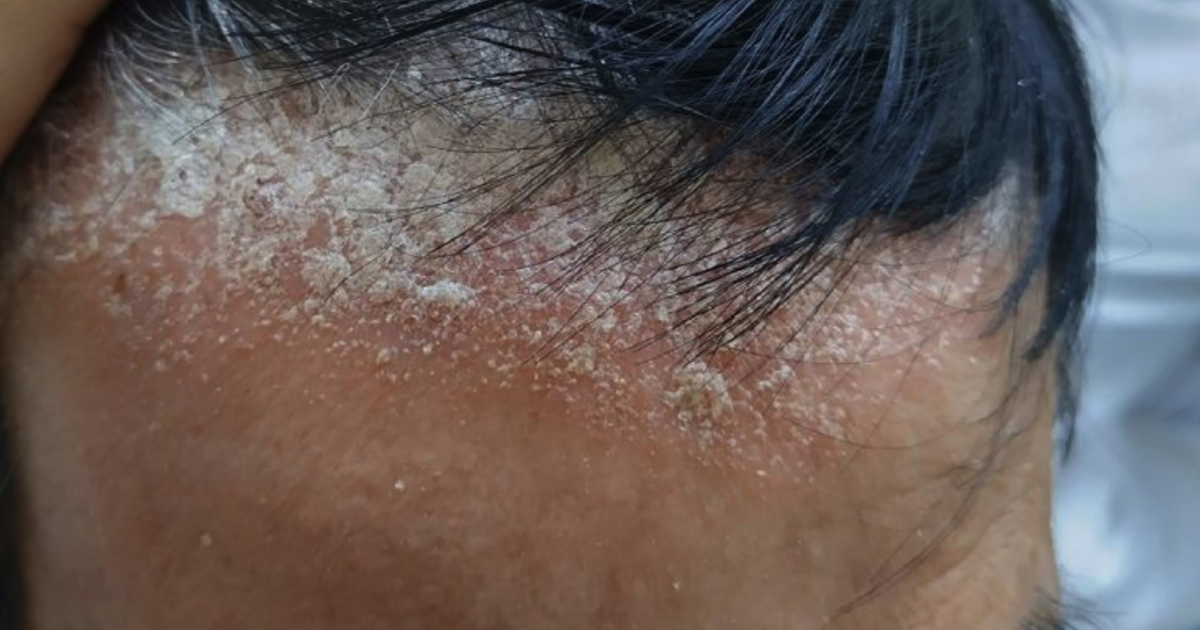 Nhuộm tóc, người đàn ông bị gàu dày như vôi trên đầu