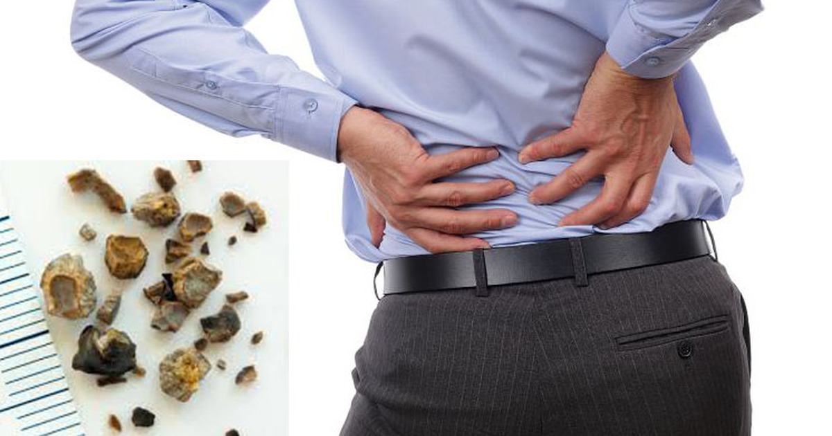 Vén bức màn bí mật xung quanh bệnh sỏi thận