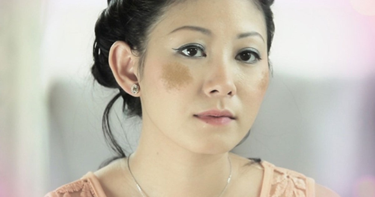 Kem trị nám có thực sự mang lại hiệu quả như quảng cáo?