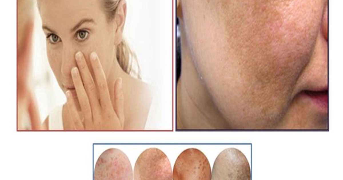 Bị nám da lâu năm, nên điều trị bằng phương pháp gì?