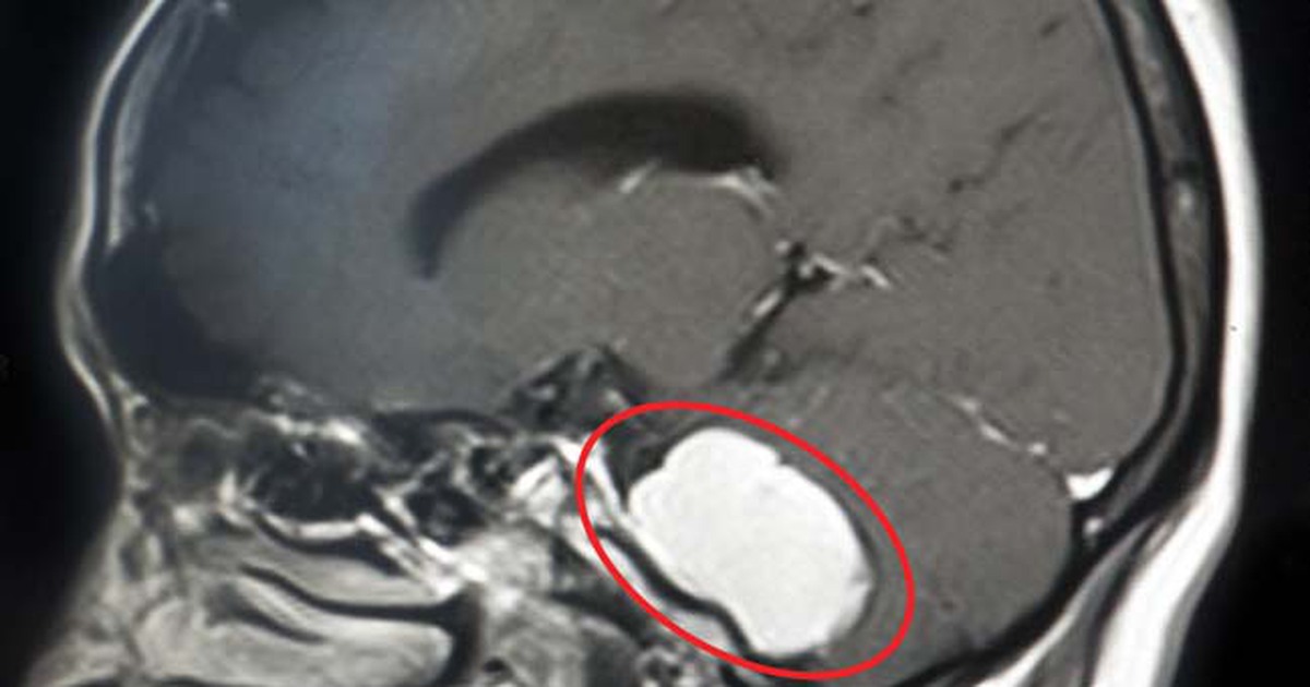 Lấy ra khối u to như quả bóng bàn trong não bệnh nhân