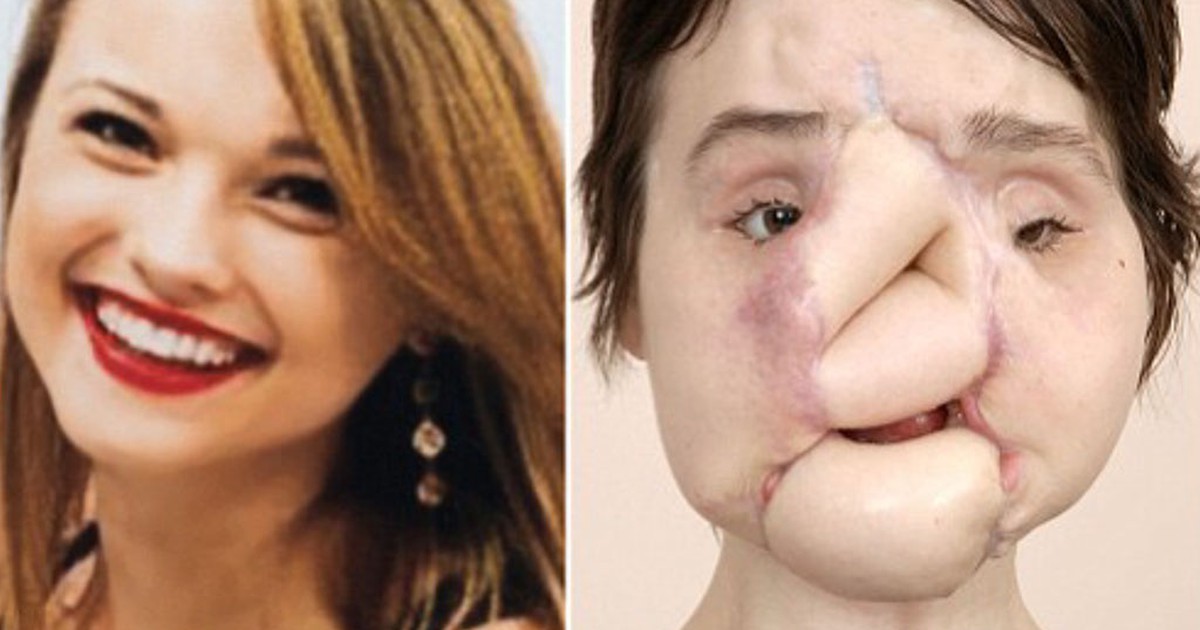 Cô gái dùng súng bắn vào mặt mình đã được cấy ghép gương mặt xinh đẹp