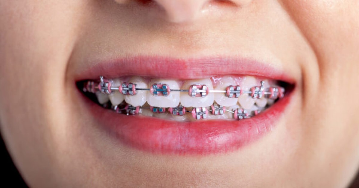 Chớ bao giờ ăn 5 loại thực phẩm này khi bạn đã niềng răng