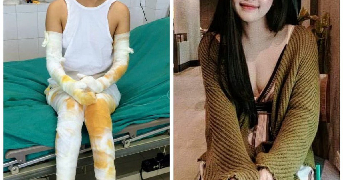 Nóng trên mạng xã hội: Cô gái bỏng toàn thân vượt qua nghịch cảnh, hóa xinh đẹp