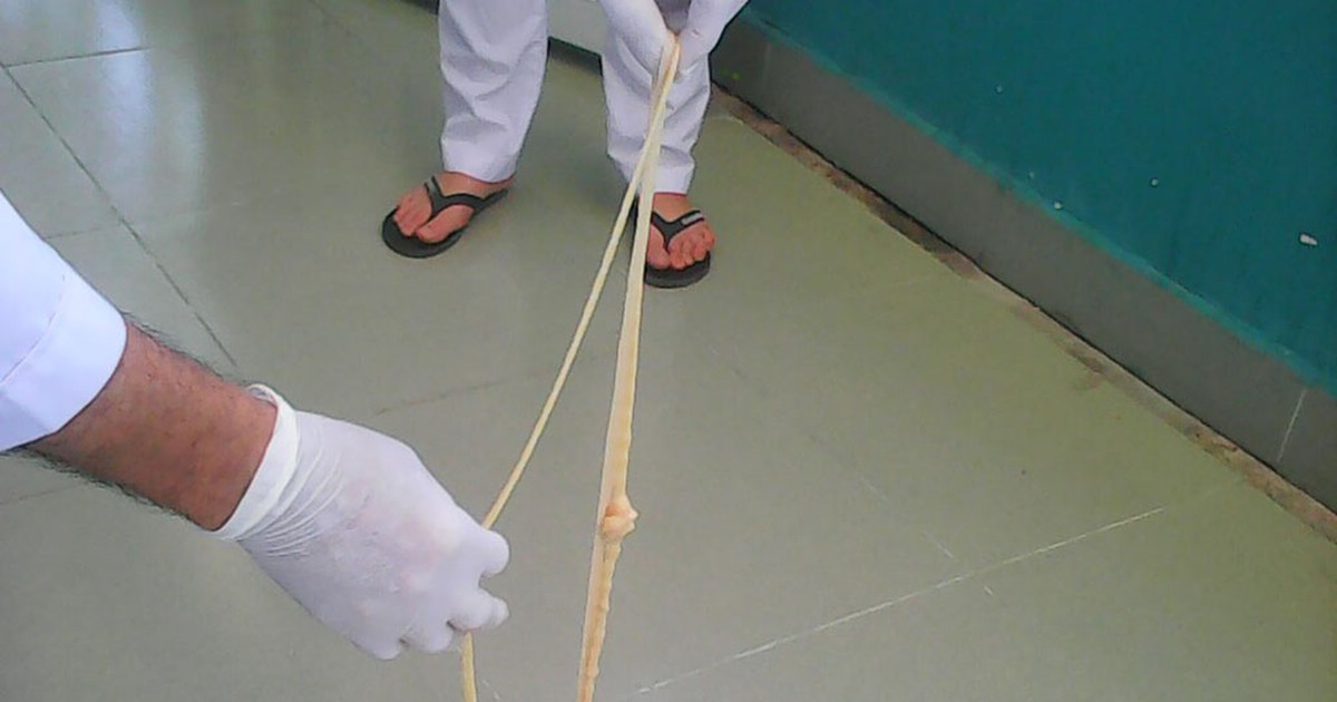 Lấy con sán xơ mít dài hơn 8 mét ra khỏi người bệnh