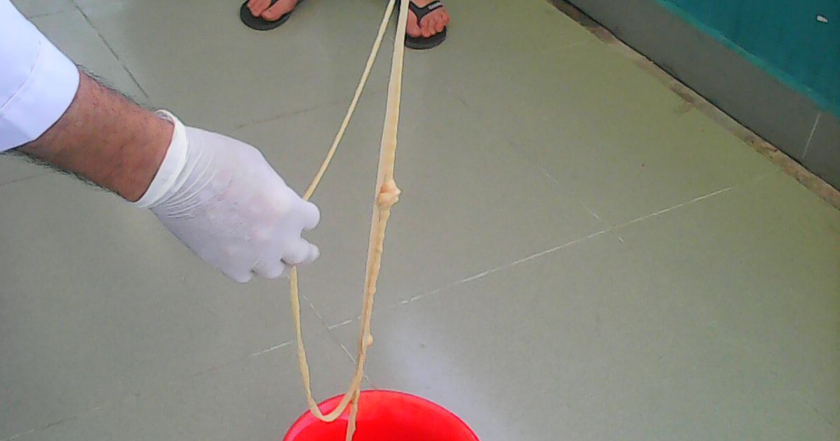 Lấy con sán xơ mít dài 6 mét ra khỏi bệnh nhân nữ