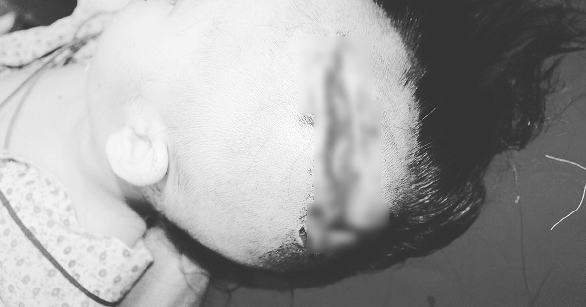 Bé 2 tuổi ở Hà Nội bị chó cắn rách đầu, nát mặt