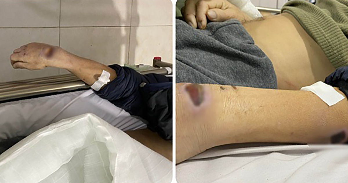 Hai cựu cán bộ công an huyện dùng nhục hình khiến bị can tử vong như thế nào?