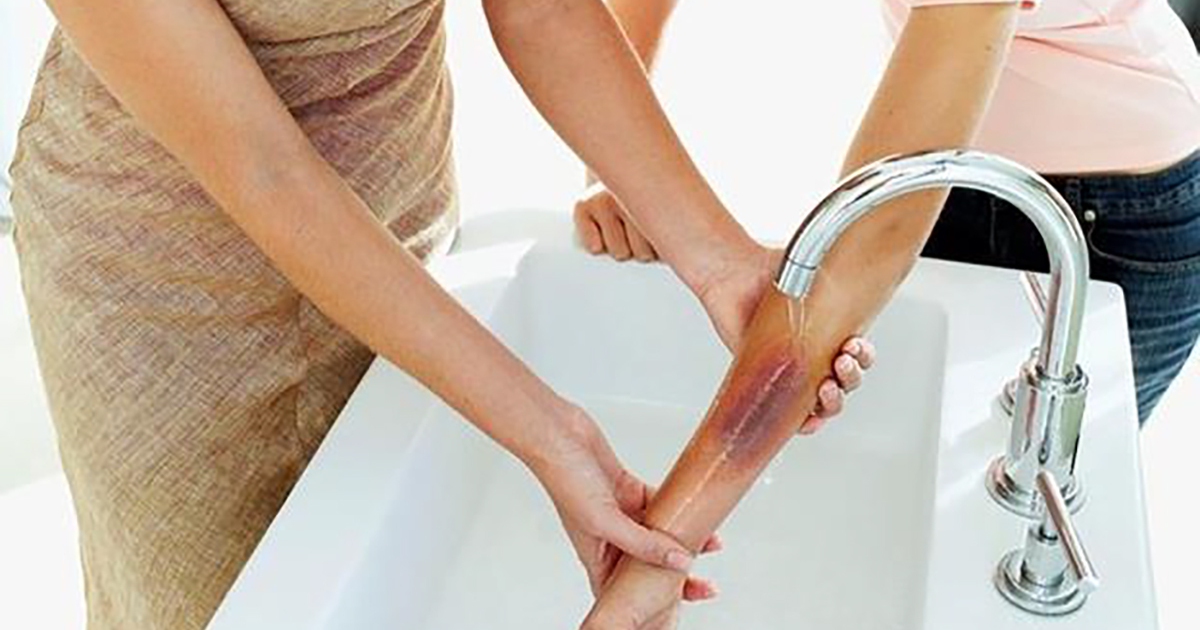 Chẳng may bị sẹo bỏng phải làm ngay điều này