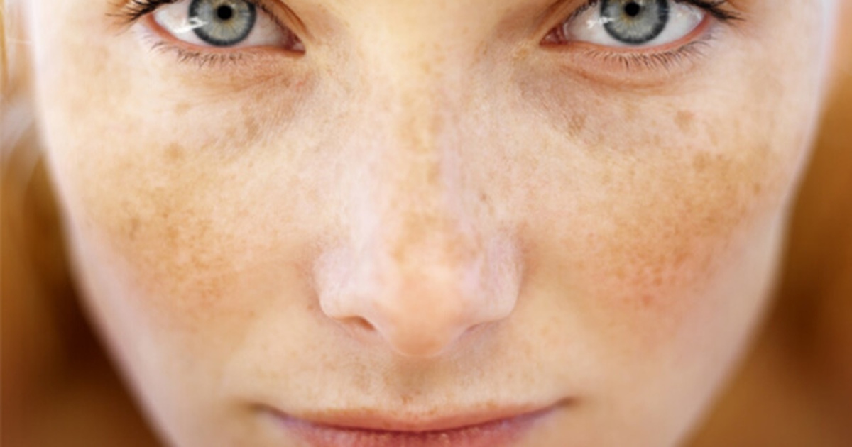 Nám da khi còn trẻ: Nguyên nhân và cách chữa trị