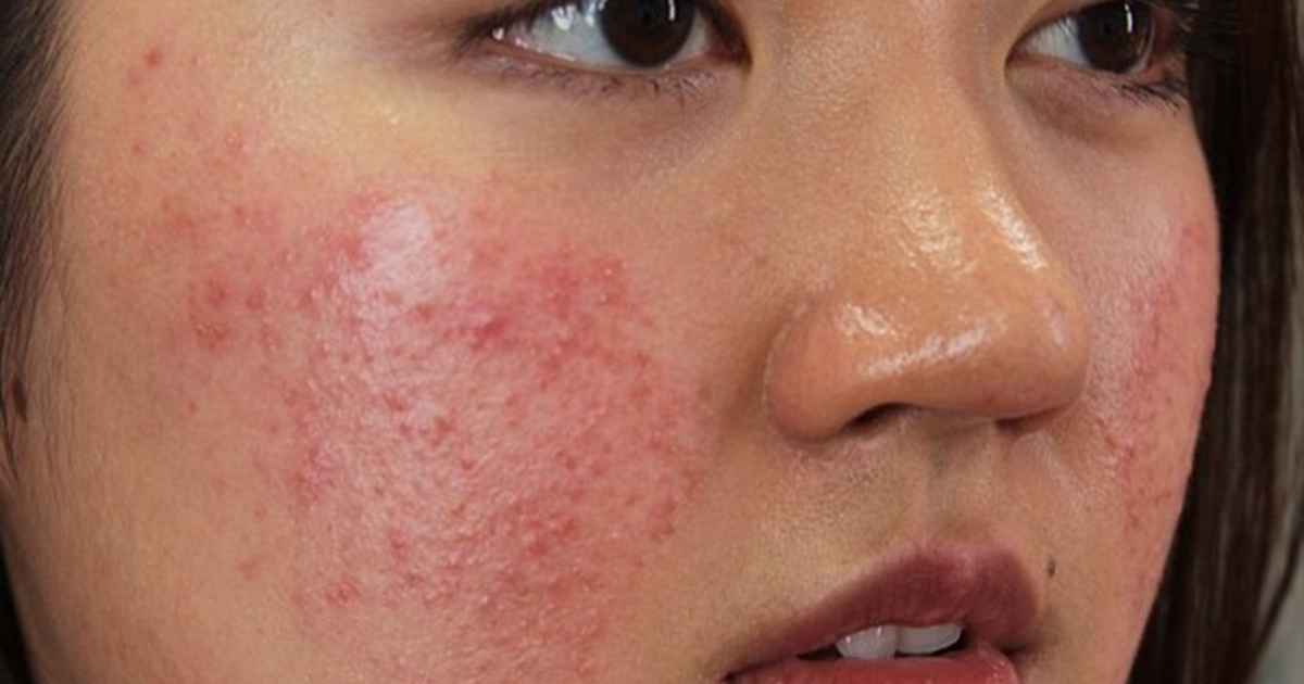 Da nổi mụn nhỏ li ti như mụn bị dị ứng, phải điều trị ra sao?