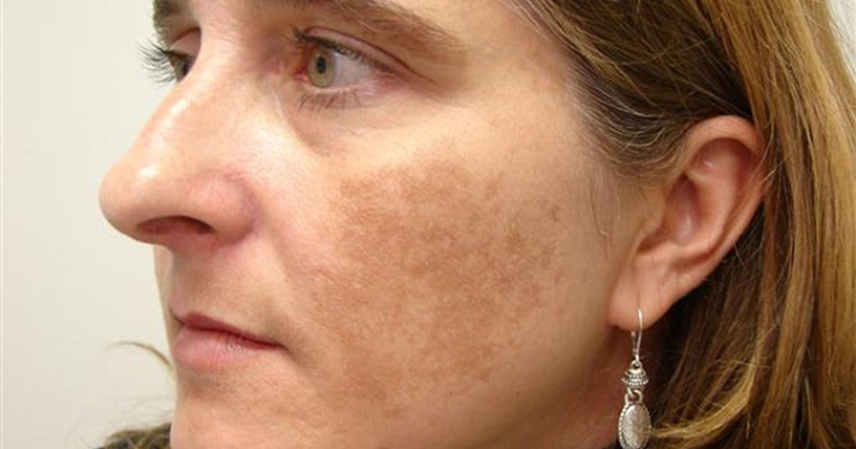 Nám mảng to ở hai bên má trị sao để hết nhanh lại không tái phát?