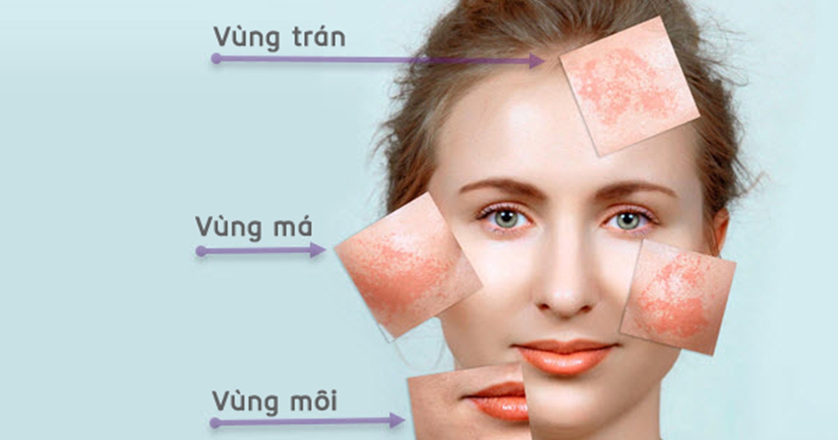 Nám da và phác đồ điều trị ‘chuẩn không cần chỉnh’