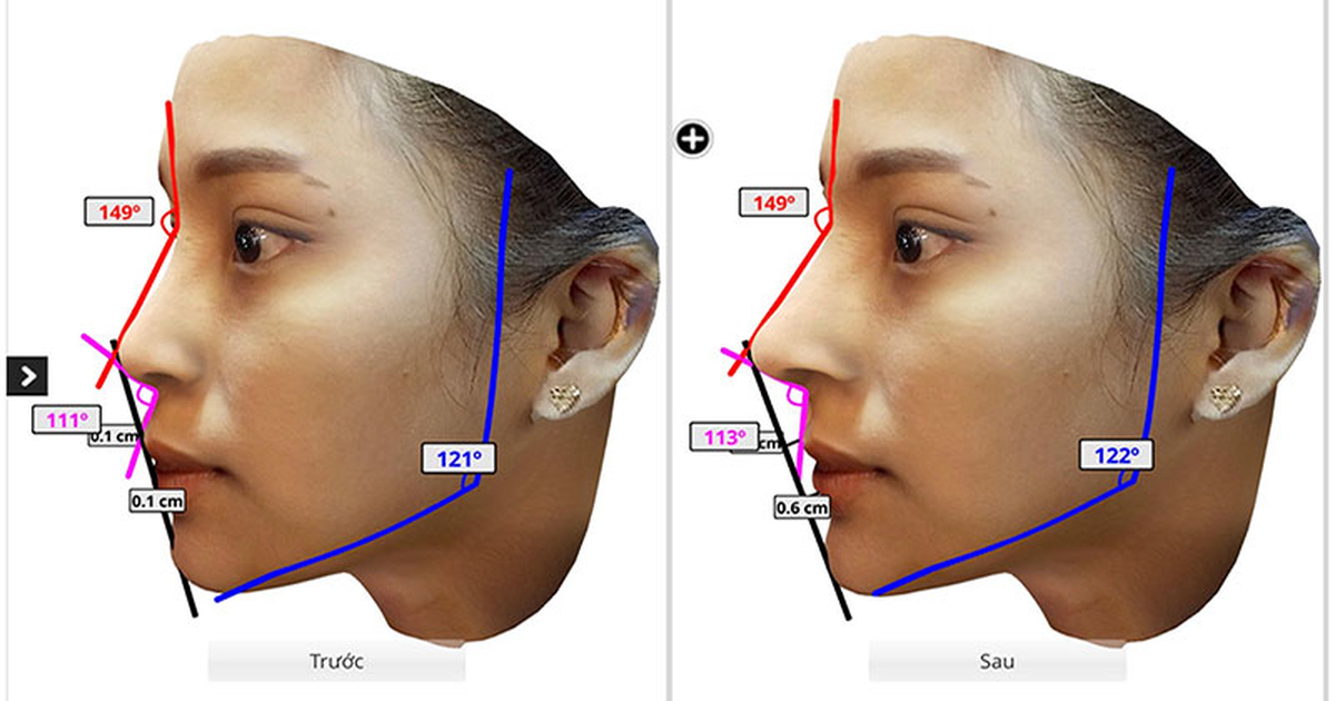 Mách bạn cách chọn lựa dáng mũi phù hợp với gương mặt