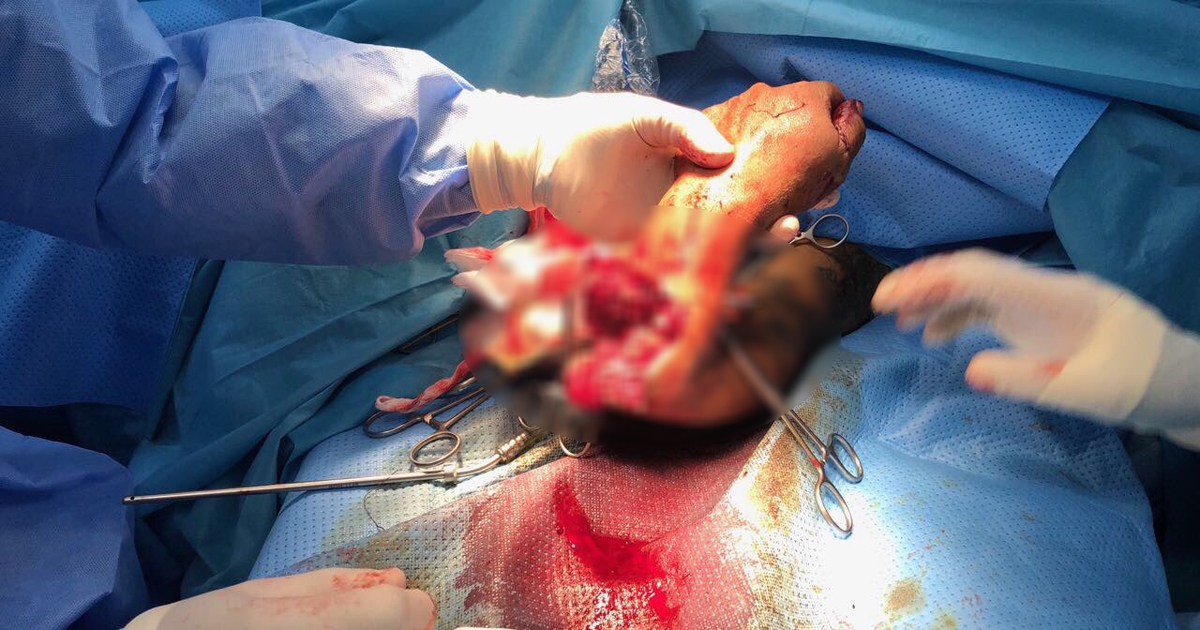 Xác định, truy bắt nhóm côn đồ chém lìa tay người bán nước