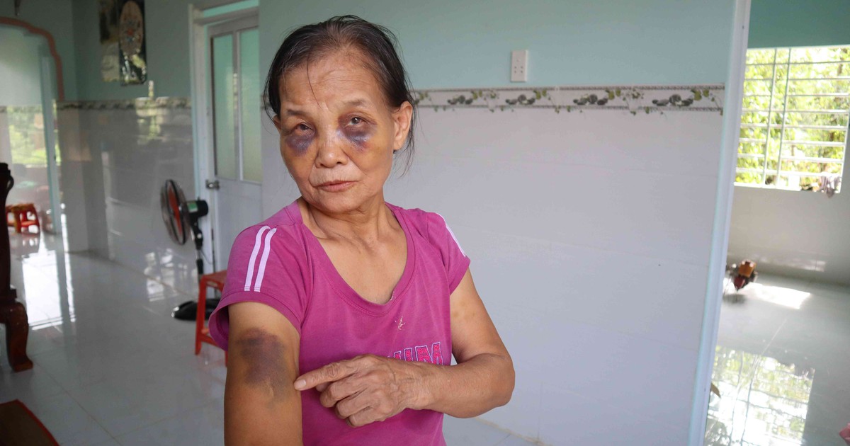 Vụ con dâu đánh mẹ chồng bầm tím mắt: Xin lỗi mẹ chồng tại công an xã