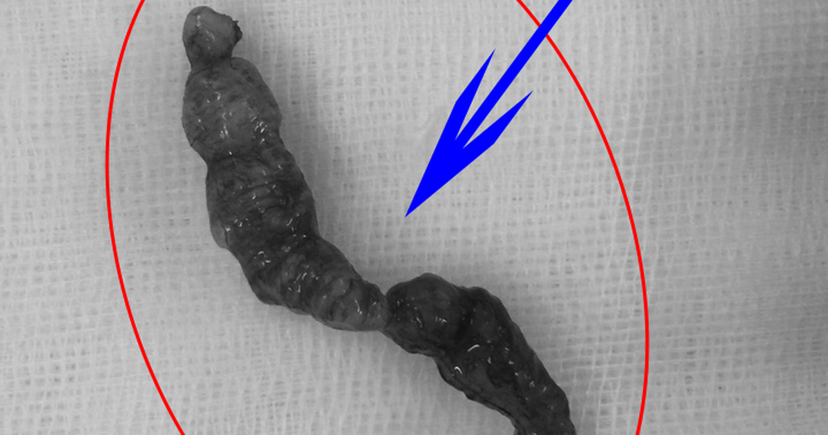 Cứu người đàn ông mắc khối u trong tủy sống dài đến 8 cm