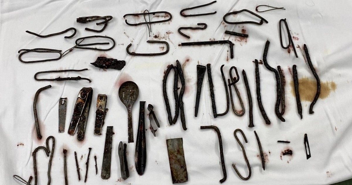 Cấp cứu nam thanh niên 'ăn' cả ký đinh, móc sắt, muỗng, đồ cắt móng tay...