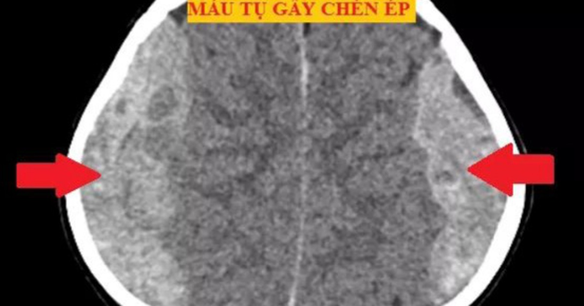 Bé trai 4 tuổi té giường tầng bị chấn thương sọ não nặng