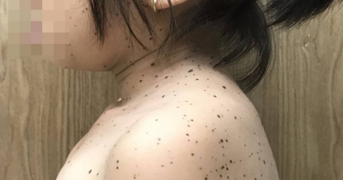 Bé gái 8 tuổi mắc hội chứng Leopard được chẩn đoán lần đầu tại Việt Nam